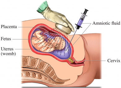 amniocenteză